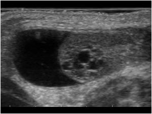 Longitudinal image of a 3 weeks old boy with a scrotal swelling. There is a small hydrocele. The right testis shows cystic changes at the rete testis
