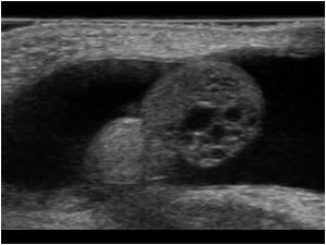 Transverse image of the same testis with cystic changes