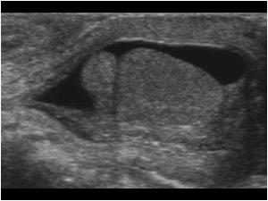 Longitudinal image of the normal left testis and epididymis. There is also a small hydrocele. 
