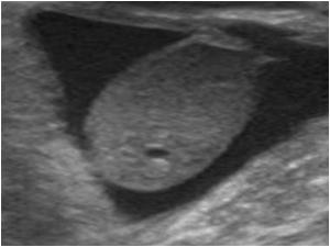 Image of the same testis several weeks later. The cystic structures are now nearly completeky diminished