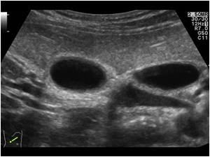 Transverse image of the right upper abdomen showing two cystic structures next to eachother