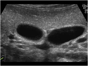 Another transverse image of the two cystic structures
