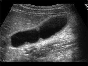 Longitudinal image of one of the two cystic structures