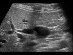 One of the cystic structures is in continuity with the intrahepatic bile ducts