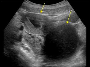 Longitudinal image of the lower abdomen and the cystic structure and a uterus with a fluid filled endometrial cavity