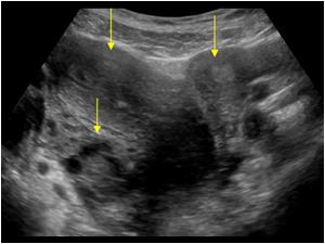 Another transverse omage showing two uterine bodies
