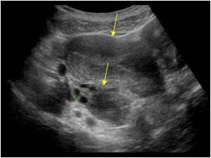 Longitudinal image of the normal uterine body and normal uterine cavity on the left side of the patient