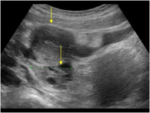 Transverse image of the normal left uterine body and left ovary
A double uterus is called a uterus didelphys.This patient also had a double or septated vagina of which the right side was occluded causing the hematometra and hematocolpos
