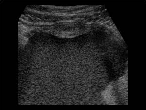 Ovarian carcinoma posterior of the vagina