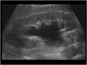 Hydronephrosis of the right kidney longitudinal