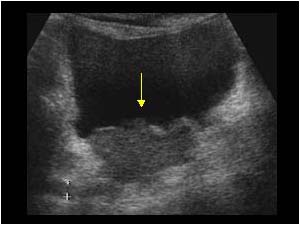 Invasive mass arising from the posterior bladder wall with dilatated right ureter