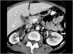 Bilateral urinary tract obstruction after bilateral stent placement