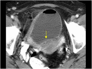 Invasive mass arising from the posterior bladder wall