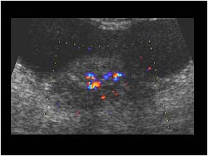 Infiltration and perforation of the bladder wall