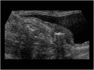 Infiltration and perforation of the bladder wall