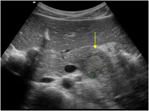Transverse image showing a nearly isoechoic mass in the tail of the pancreas