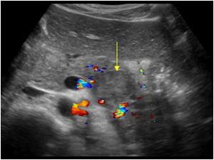 Color doppler image of the pancreas with the same lesion