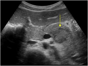 Another transverse image of the pancreas