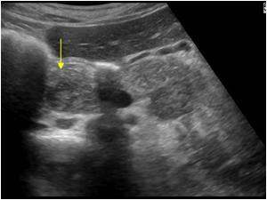 Transverse image of the pancreatic head showing a smaller second lesion