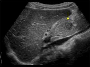 Longitudinal image of the second smaller lesion in the head of the pancreas
