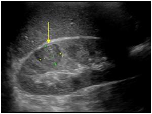 Longitudinal image of the right kidney showing a small nearly isoechoic mass in the upperpole