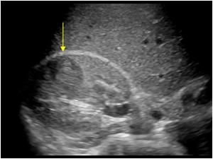 Transverse image of the right kidney showing the same mass