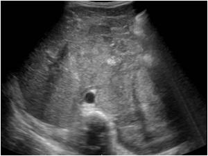 Transverse image of the abdomen showing a large tumor mass encasing the large vessels