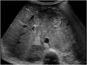 Transverse image showing the tumor extending towards the right kidney
