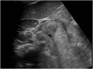 Transverse image showing the tumor extending towards the right kidney