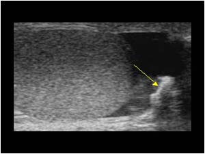 Scrotal phlebolith with acoustic shadowing