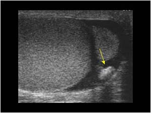 Scrotal phlebolith with acoustic shadowing