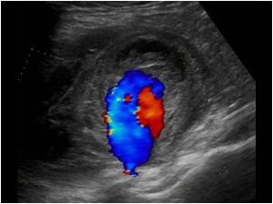 Withe color doppler on the lesion shows flow