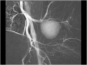 an angiogram was performed