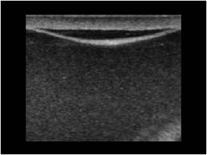 Large spermatocele with low level echos and echo free fluid in the tunica vaginalis