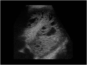 Echogenic pleural effusion with septations