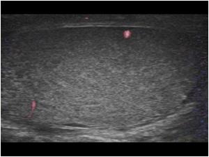 Another color doppler image of the right testis. There are less vessels seen than on the left side