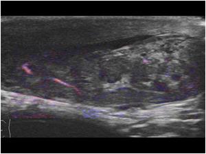 The epididymis is slightly thickened and shows vessels with color doppler. Does this mean that there is an epididymitis?