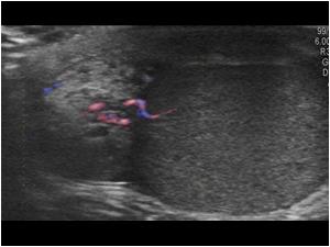 Transverse image of the epididymis and right testis with flow