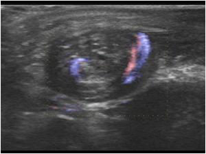 A spiral aspect always means that there is a torsion. This is an indication for immediate surgery. Sometimes there is some flow visible in the testis and or epididymis, when the tosion is not complete. However this can very easily change. 