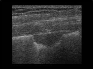 Wedge shaped hypoechoic pleural based lesion