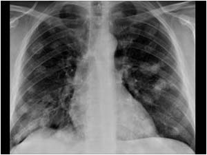 Pulmonary masses