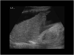 Atelectasis of the left lower lobe and echofree pleural fluid