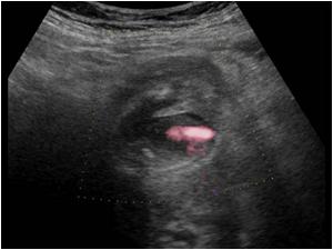With color doppler ther is a pulsatile jet into the gallbladder