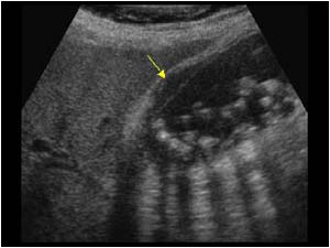 Cholecystitis with multiple floating gallstones