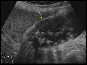 Cholecystitis with a thickened gallbladder wall
