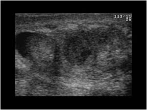Thickened epididymis with a small abscess