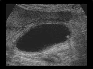 Acute cholecystitis with gallstone longitudinal