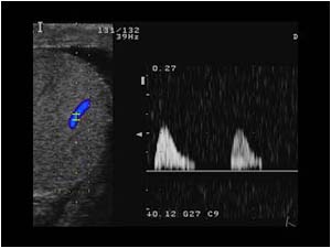 High resistance flow pattern in the left testicle