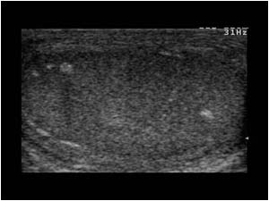 Atrophy of the left testicle with calcifications