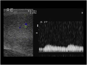 Normal low resistance flow pattern in the right testicle